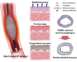 Image result for Radiofrequency Surgery