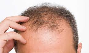 Certain medical conditions are linked to hair loss. Balding Istanbul Hair Clinic