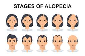 Image result for Alopecia