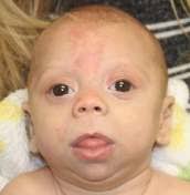 Characterization of the Beckwith‐Wiedemann spectrum: Diagnosis and  management