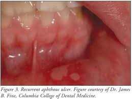 I suffered from geographic tongue and through a strange set of circumstances i learned how to get rid of it. Treatment Of Common Oral Lesions