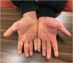 Image result for scabies norvegica