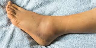 Versteckte Entzundungen Im Korper 6 Spannende Fakten