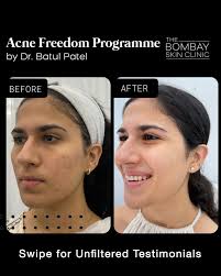 Real results, real stories! ✨ Witness this incredible transformation at The  Bombay Skin Clinic with our Acne Freedom Programme & MNRF  treatment—designed to clear, heal, and renew your skin. Swipe to hear
