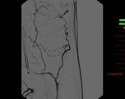 You can find all ways to contact us here. Einsatz Des Outback Reentry Katheters Zur Rekanalisation Eines Gelenkuberschreitenden Langstreckigen Verschlusses Der A Femoralis Und A Poplitea Springerlink