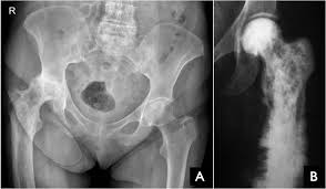 Radiology Signs Paget S Disease Of Bone A Chronic Bone Disorder