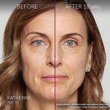 Sculptra should not be injected into the blood vessels as it may cause vascular occlusion, infarction or embolic phenomena. Sculptra Filler Injection Injectables Near Me Lazaderm Laser Aesthetics