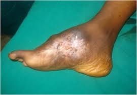 The inflammatory response can extend. Pathology Outlines Fungi Maduramycosis