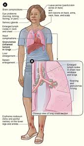 Sarcoidosis with cancer immunotherapy, mistaken for cancer progression. Sarcoidosis Wikipedia