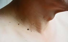 How To Remove Skin Tags My Blog