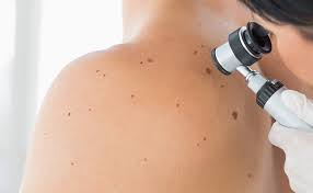 Our practices are conveniently located in and near major counties and cities such as los angeles, las vegas and phoenix. Skin Cancer Screening In Leeds Skin Surgery Clinic