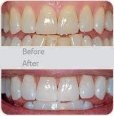 Wedding Day White Teeth My Dentist Actually Told Me About This Use A Little Toothpaste Mix In One Teaspoon B Beauty Hacks Health And Beauty Tips White Teeth