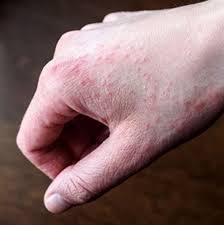 Kulit kering dapat terjadi di bagian tubuh mana saja. Awas Penyakit Hand Dermatitis Punca Jari Merah Dan Gatal Gatal Kartel Dakwah