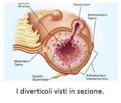 La stenosi diverticolare sintomatica del.→ #papa francesco Dieta Per La Malattia Diverticolare Roma Gastroenterologo Dott Prof Antonio Iannetti