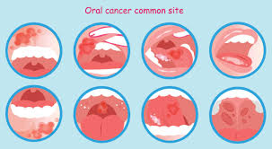 Image result for gums cancer symptoms