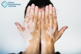 Image result for Vitiligo