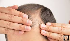 The reasons that cause hair fall include lack of proper diet, sudden weight loss among men, deficiency in minerals, stress, medicines, and diet are some of the common causes behind hair fall. 6 Prominent Causes Of Hair Loss In Men Ahs India