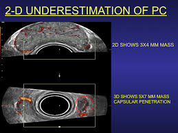 4 D Guided Prostate Treatment The Future Of Oim Directed