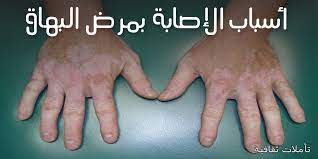 مرض البهاق اسبابه وعلاجه كيف اتخلص منه و كيف اتقيه اجمل بنات