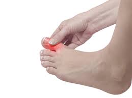 Image result for gout symptoms toe
