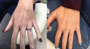 Some people choose to get their tattoos removed by going under the knife. Laser Tattoo Removal Before And After Photos Cosmetic Dermatology Knoxville Tn