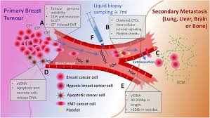 Recurrent breast cancer occurs when the disease has returned after initial treatment. Frontiers Circulating Tumor Cells In Metastatic Breast Cancer From Genome Instability To Metastasis Molecular Biosciences