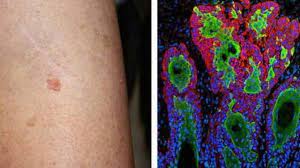 Skin cancer is one of the most common types of cancer. New Skin Cancer Treatment Method By Iisc Researchers Through Magnetic Nano Fibres Bandage Skin Cancer à®š à®• à®š à®š à®¯ à®² à®‡à®¨ à®¤ à®¯ à®†à®° à®¯ à®š à®š à®¯ à®³à®° à®•à®³ à®…à®Ÿ à®¨ à®¤ à®® à®ª à®° à®® à®µ à®± à®± Science News In Tamil