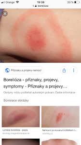 Flak na nohe po vybrati kliesta mozna borelioza modry konik. Co By To Mohlo Byt Svrbiaci FÄ¾ak Ale Nevieme Z Coho Modry Konik