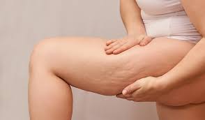 How to deal with cellulite on your stomach? How To Get Rid Of Cellulite Fast Nutrex Research