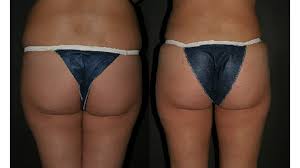 As to the maximum sum, it can reach up to $14,000. Brazilian Butt Lift Procedure Benefits Side Effects And Cost