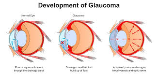 It usually happens when fluid builds up in the front part of your eye. Glaucoma Livingston What Is Glaucoma Associates In Ophthalmology