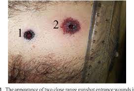 The forensic pathologists examining a gunshot wound should document the type, size, shape, site, and location like in any other injury. Double Suicidal Gunshot Wounds To The Heart Semantic Scholar