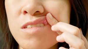 Image result for Canker sores roof of mouth