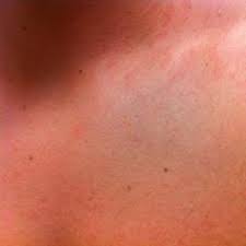 Check spelling or type a new query. Skin Rash Causes 68 Pictures Of Symptoms And Treatments
