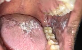 Image result for lichen planus on tongue)