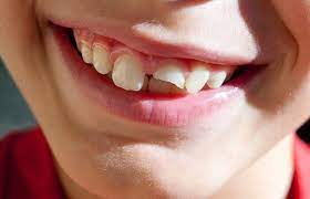 Do you have a cracked tooth? Chipped Front Tooth Treatment Savina Dental Clinics Malta Gozo