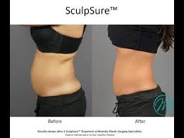 Pin On Sculpsure