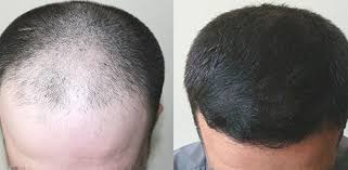 Prima e dopo micro fue · 2 mega sessioni per complessive 4500 uf (circa 9500 bulbi) · 1 seduta di ritocco · biostimolazione . Trapianto Capelli Occhio A Offerte Low Cost Su Web Ilfogliettone Itilfogliettone It