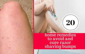 20 Quick And Easy Home Remedies To Get Rid Of Razor Bumps And Burns