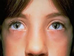 Check spelling or type a new query. Sixpenceee Congenital Iris Coloboma Is A Hole Or Defect Of