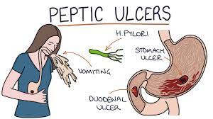 Understanding Stomach And Duodenal Ulcers - Youtube