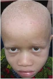 Genotypic spectrum of albinism in Mali