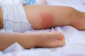 Adverse Antibiotic Reactions Often Put Kids In Ed Cidrap