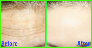 Trying to conceal and the straight lines from the long hair cut the roundness in her cheeks, . How To Get Rid Of Forehead Wrinkles 10 Home Remedies