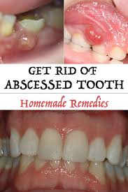Check spelling or type a new query. Otc Antibiotics For Tooth Infection Tooth Abscess Causes Symptoms And Treatment