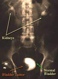 Bladder stones irritate the lining of the bladder blood in the urine, straining to urinate and increased frequency of urination. Bladder Cancer Screening And Diagnosis Johns Hopkins Medicine