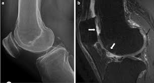 Image result for Ballottable Patella Sign