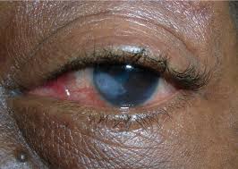 We are indebted to our patients. Nongenital Herpes Simplex Virus American Family Physician