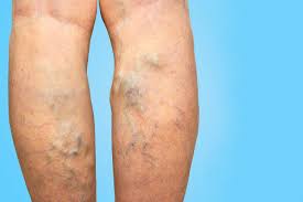 Back view of lower legs showing prominent varicose veins on the calves