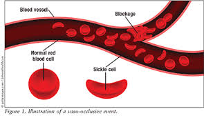 What is sickle cell disease (scd)? Sickle Cell Disease Pain Management